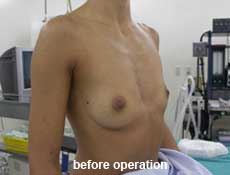 plastic-surgery-breast-augmentation 